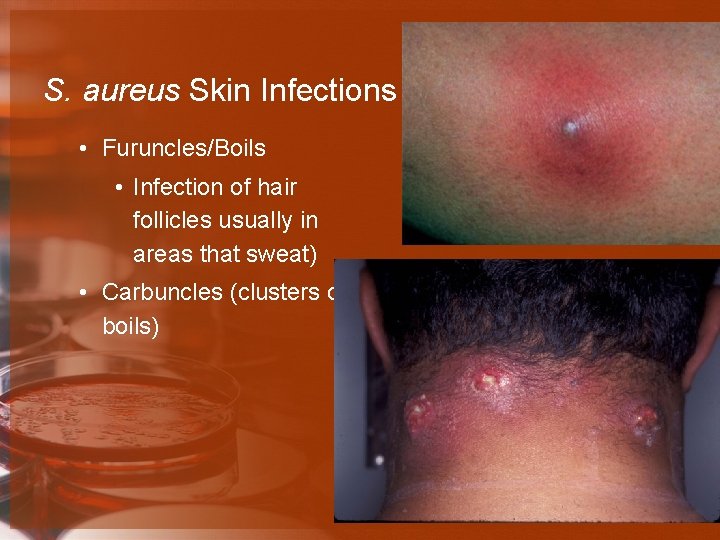 S. aureus Skin Infections • Furuncles/Boils • Infection of hair follicles usually in areas