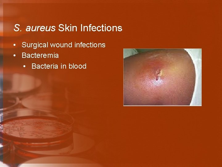 S. aureus Skin Infections • Surgical wound infections • Bacteremia • Bacteria in blood