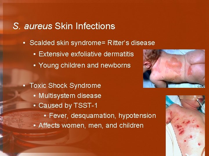 S. aureus Skin Infections • Scalded skin syndrome= Ritter’s disease • Extensive exfoliative dermatitis