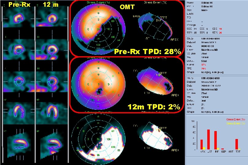 Pre-Rx 12 m OMT Pre-Rx TPD: 28% 12 m TPD: 2% Pre-Rx 12 m OMT Pre-Rx TPD: 28% 12 m TPD: 2%