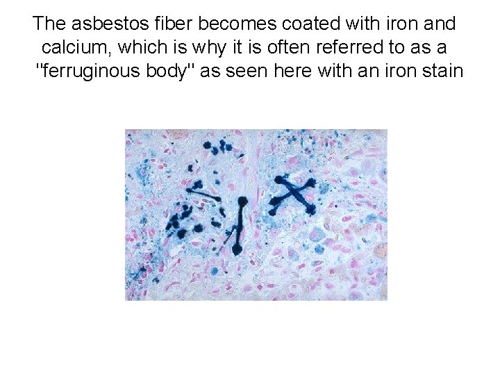 The asbestos fiber becomes coated with iron and calcium, which is why it is