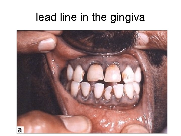 lead line in the gingiva 