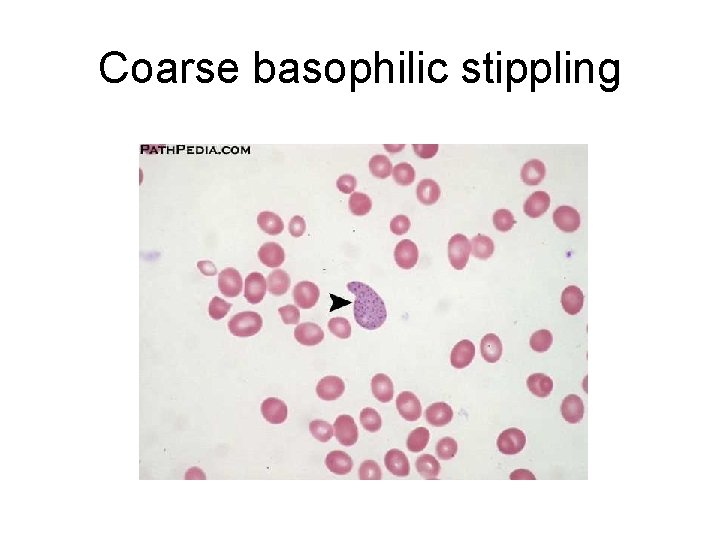 Coarse basophilic stippling 