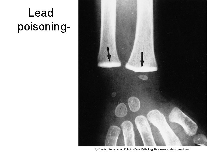 Lead poisoning- 