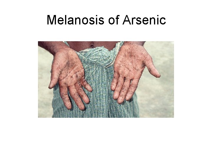 Melanosis of Arsenic 