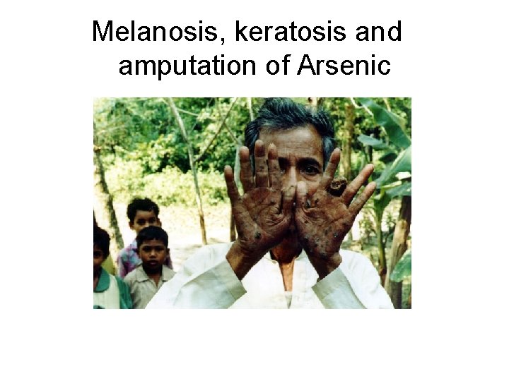 Melanosis, keratosis and amputation of Arsenic 