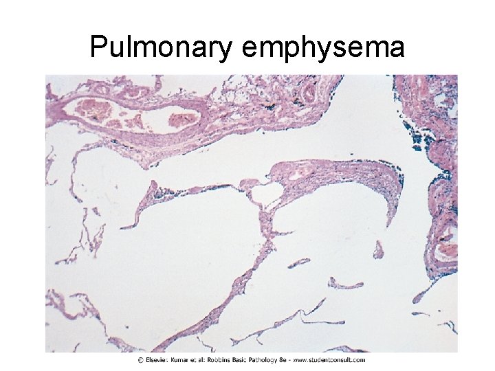 Pulmonary emphysema 