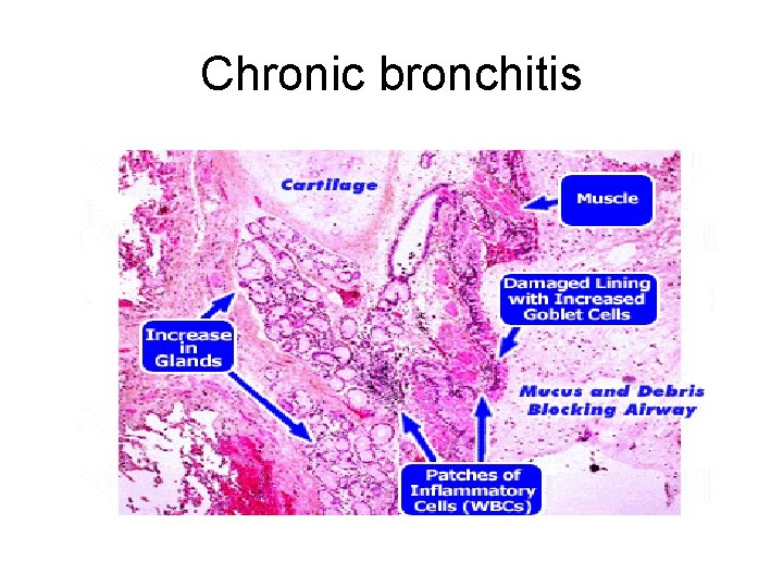 Chronic bronchitis 