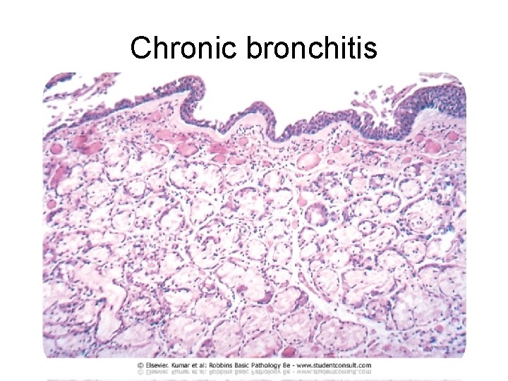 Chronic bronchitis 