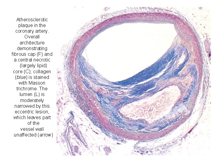 Atherosclerotic plaque in the coronary artery. Overall architecture demonstrating fibrous cap (F) and a