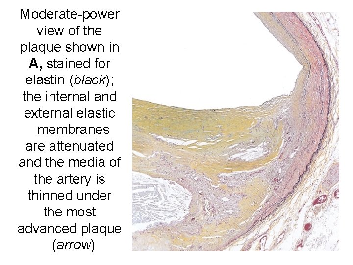 Moderate-power view of the plaque shown in A, stained for elastin (black); the internal