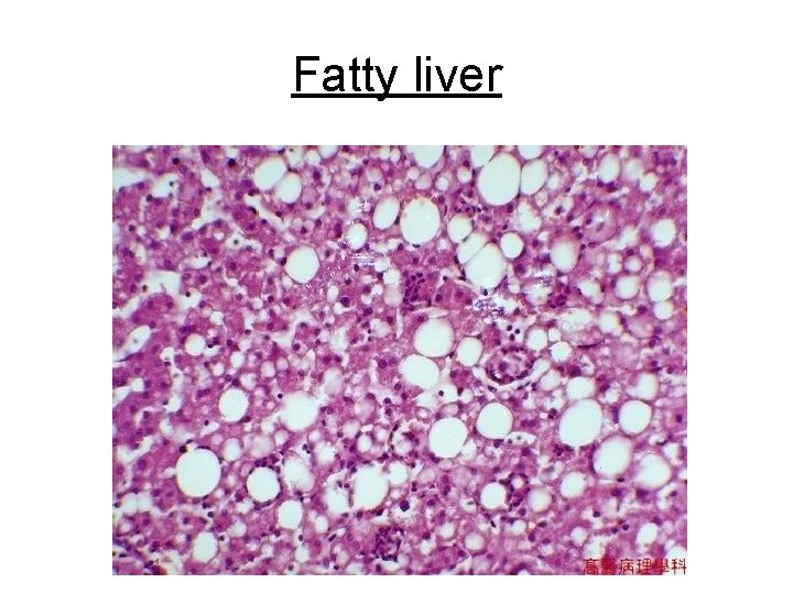 Fatty liver 