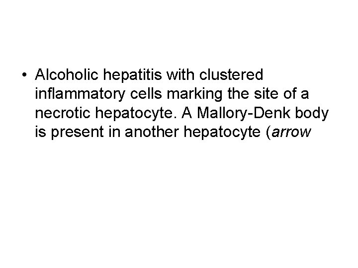  • Alcoholic hepatitis with clustered inflammatory cells marking the site of a necrotic