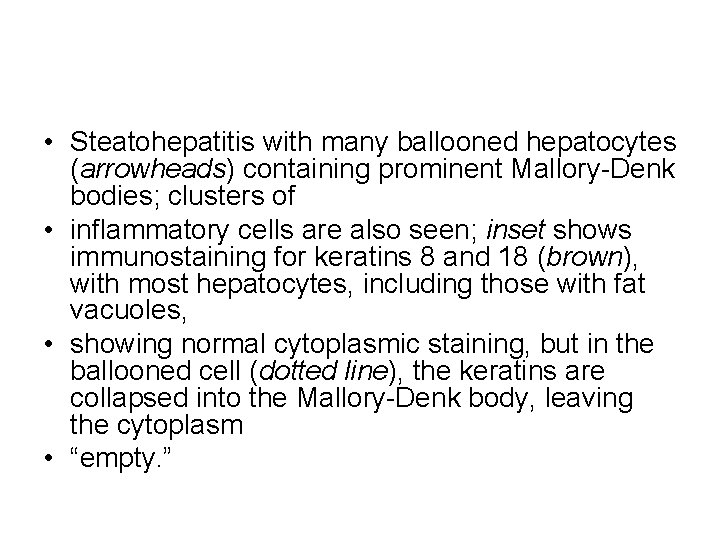  • Steatohepatitis with many ballooned hepatocytes (arrowheads) containing prominent Mallory-Denk bodies; clusters of