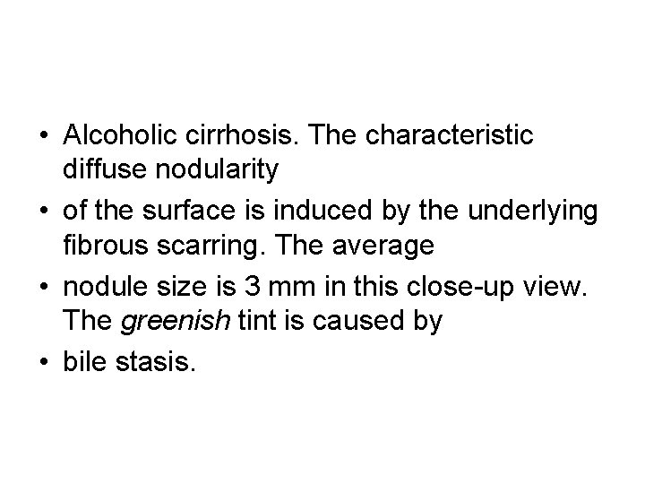  • Alcoholic cirrhosis. The characteristic diffuse nodularity • of the surface is induced