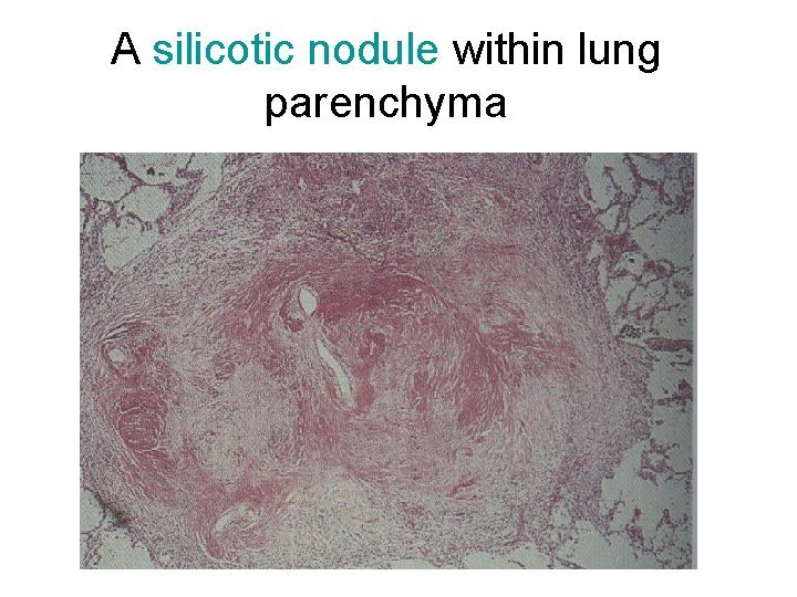 A silicotic nodule within lung parenchyma 