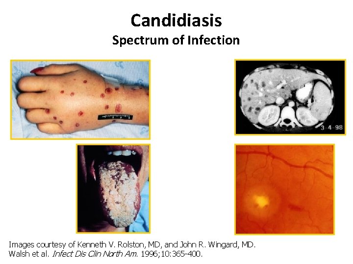 Candidiasis Cutaneous fungemia Spectrum of Infection Disseminated Mucosal Chorioretinitis Images courtesy of Kenneth V.