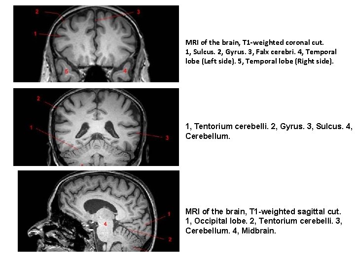 MRI of the brain, T 1 -weighted coronal cut. 1, Sulcus. 2, Gyrus. 3,