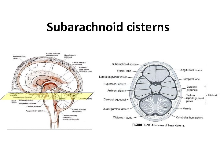 Subarachnoid cisterns 