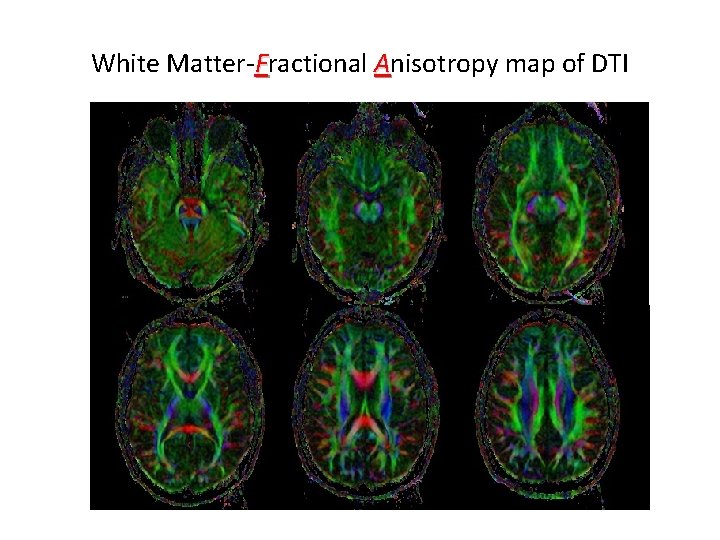 White Matter-Fractional Anisotropy map of DTI 
