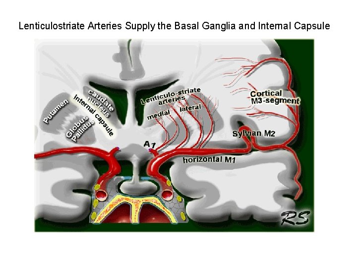 Lenticulostriate Arteries Supply the Basal Ganglia and Internal Capsule 