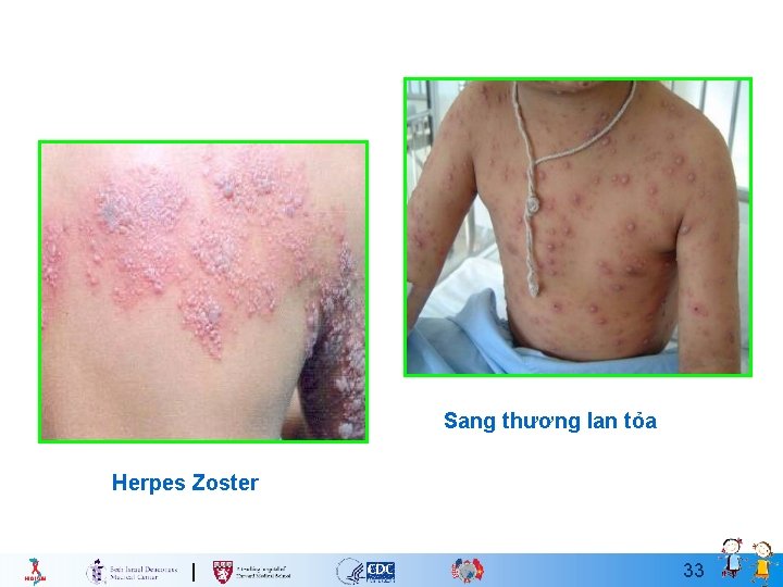 Sang thương lan tỏa Herpes Zoster 33 