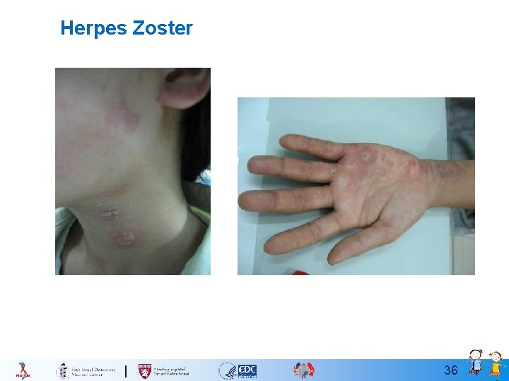 Herpes Zoster 36 