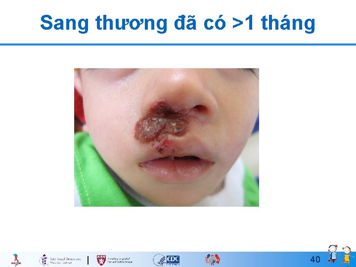 Sang thương đã có >1 tháng 40 