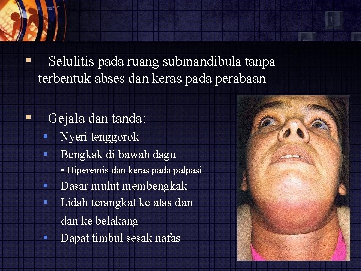  Selulitis pada ruang submandibula tanpa terbentuk abses dan keras pada perabaan Gejala dan