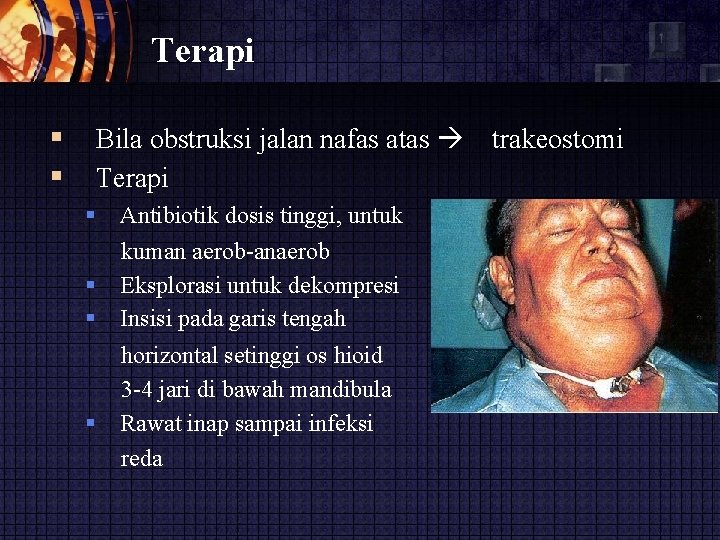 Terapi Bila obstruksi jalan nafas atas Terapi Antibiotik dosis tinggi, untuk kuman aerob-anaerob Eksplorasi