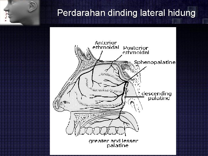 Perdarahan dinding lateral hidung 