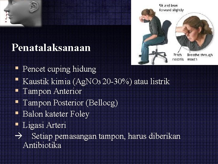 Penatalaksanaan Pencet cuping hidung Kaustik kimia (Ag. NO 3 20 -30%) atau listrik Tampon