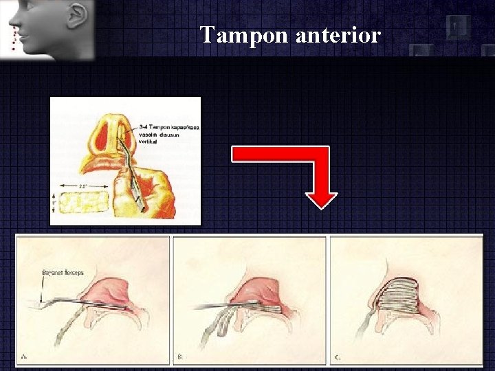 Tampon anterior 