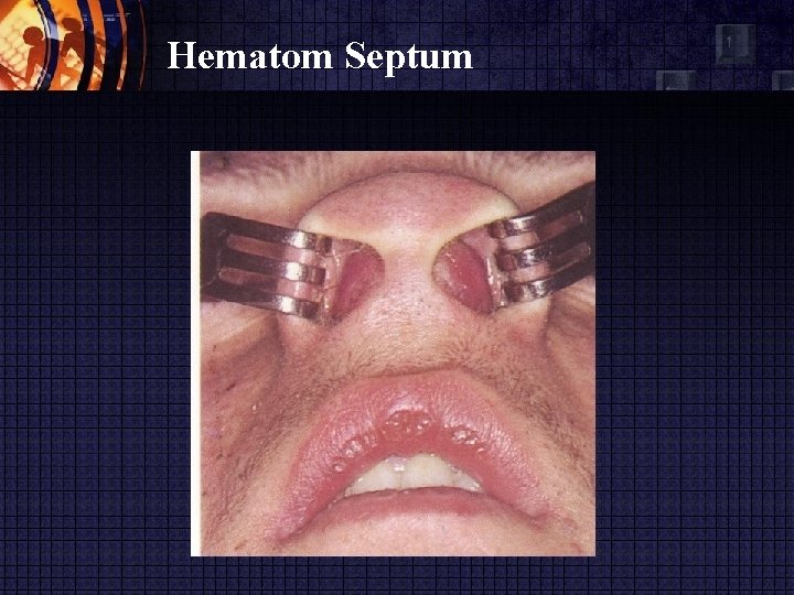 Hematom Septum 