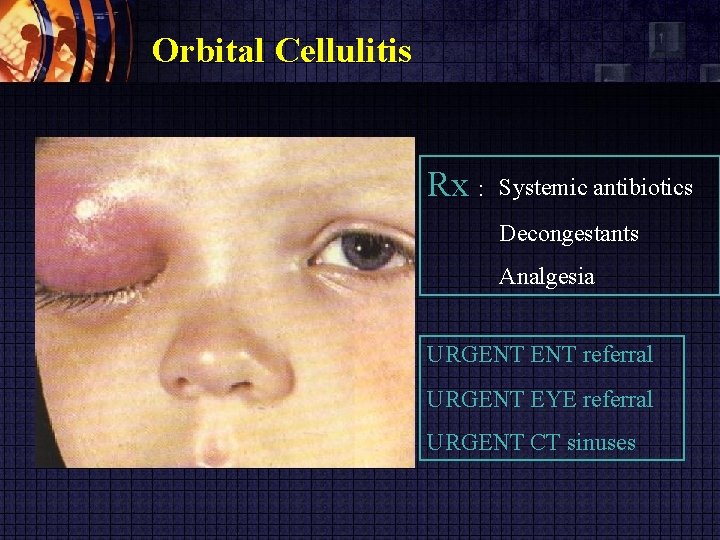 Orbital Cellulitis Rx : Systemic antibiotics Decongestants Analgesia URGENT referral URGENT EYE referral URGENT