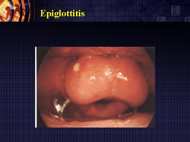 Epiglottitis 