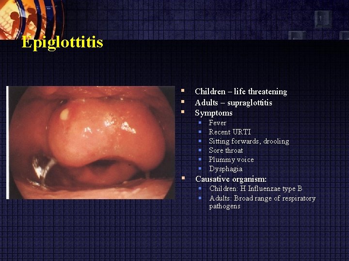 Epiglottitis Children – life threatening Adults – supraglottitis Symptoms Fever Recent URTI Sitting forwards,