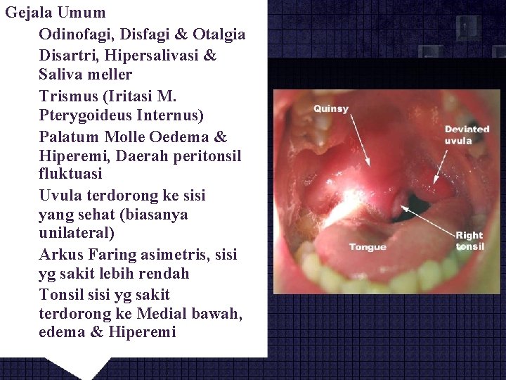 Gejala Umum Odinofagi, Disfagi & Otalgia Disartri, Hipersalivasi & Saliva meller Trismus (Iritasi M.