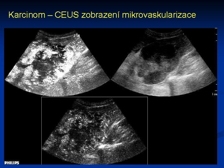 Karcinom – CEUS zobrazení mikrovaskularizace 