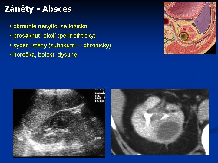 Záněty - Absces • okrouhlé nesytící se ložisko • prosáknutí okolí (perinefriticky) • sycení