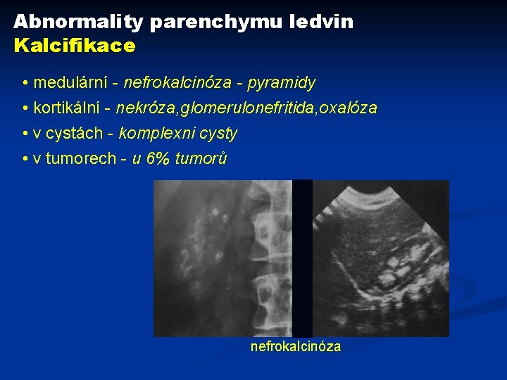 Abnormality parenchymu ledvin Kalcifikace • medulární - nefrokalcinóza - pyramidy • kortikální - nekróza,