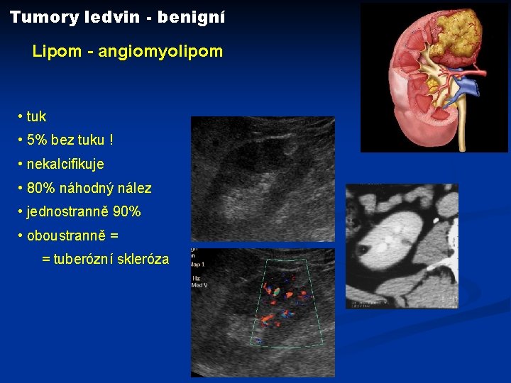 Tumory ledvin - benigní Lipom - angiomyolipom • tuk • 5% bez tuku !