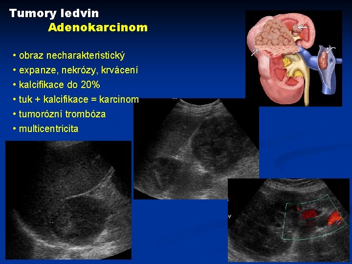 Tumory ledvin Adenokarcinom • obraz necharakteristický • expanze, nekrózy, krvácení • kalcifikace do 20%
