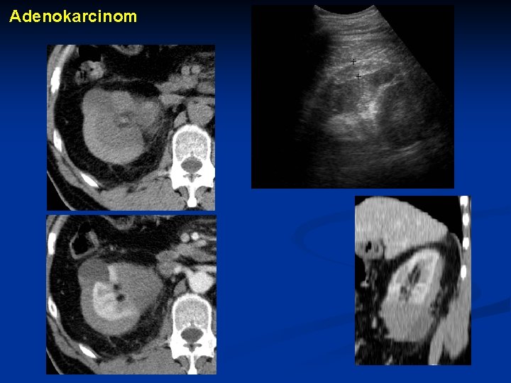 Adenokarcinom 