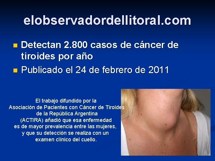 elobservadordellitoral. com Detectan 2. 800 casos de cáncer de tiroides por año n Publicado