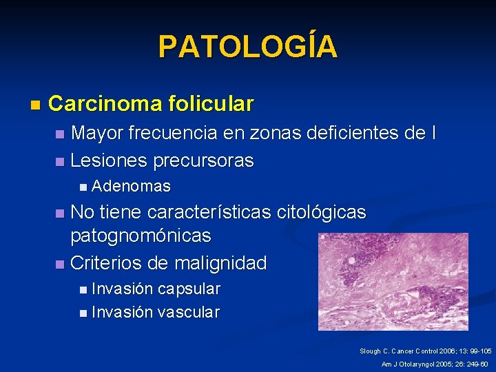 PATOLOGÍA n Carcinoma folicular Mayor frecuencia en zonas deficientes de I n Lesiones precursoras