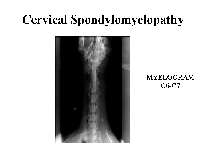 Cervical Spondylomyelopathy MYELOGRAM C 6 -C 7 