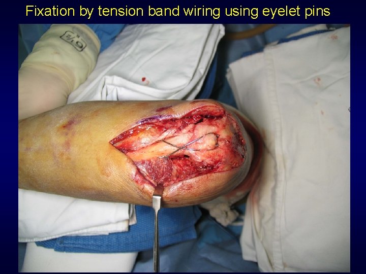 Fixation by tension band wiring using eyelet pins 