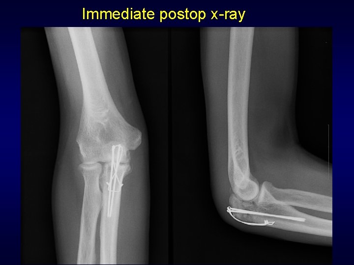 Immediate postop x-ray 