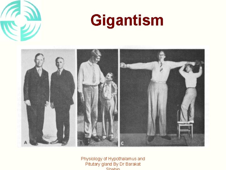 Gigantism Physiology of Hypothalamus and Pitutary gland By Dr Barakat 